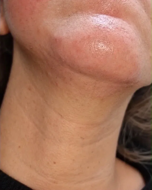 Épilation laser du menton et cou à Chessy, après le soin