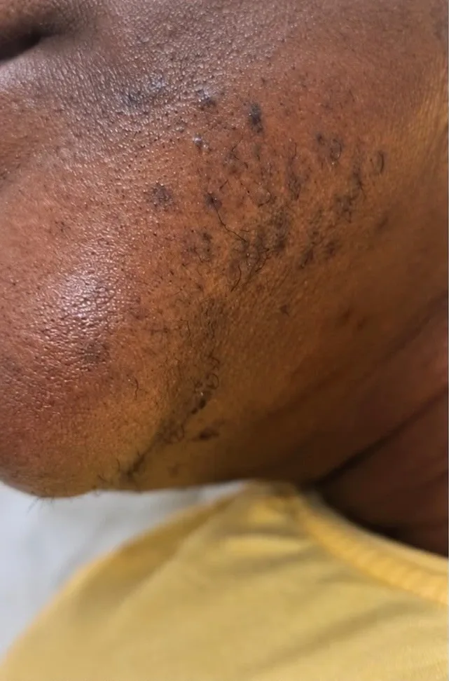 Épilation laser du menton à Chessy, avant le soin : poils foncés et denses sur le menton au départ