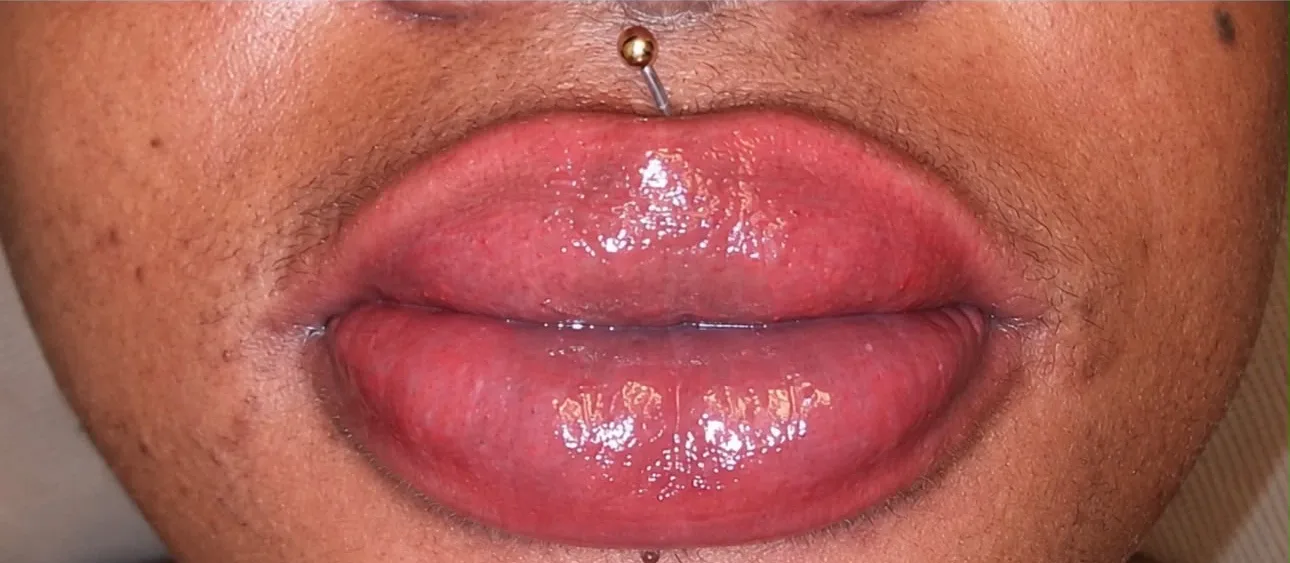 Candy lips à Chessy, après le soin : lèvres pigmentées