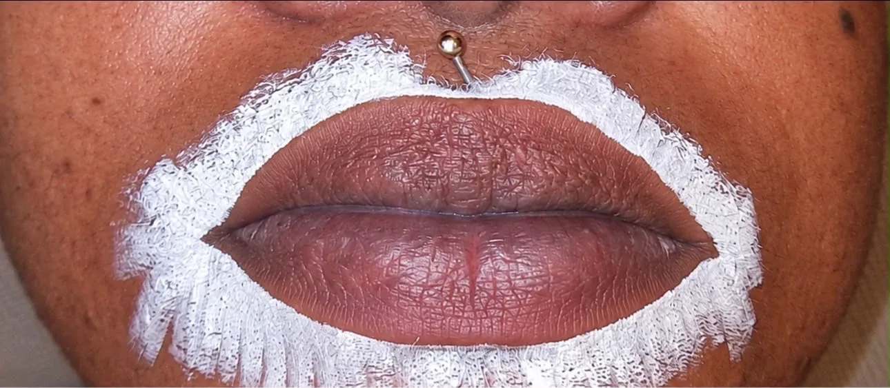 Candy lips à Chessy, avant le soin : lèvres foncées au départ
