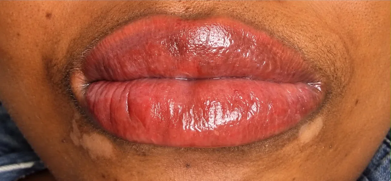 Candy lips à Chessy, après le soin : contour unifié
