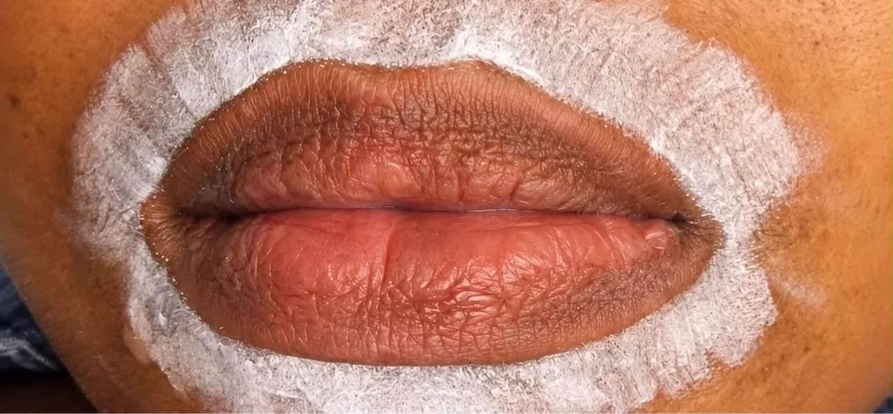 Candy lips à Chessy, avant le soin : contour plus foncé que le centre au départ