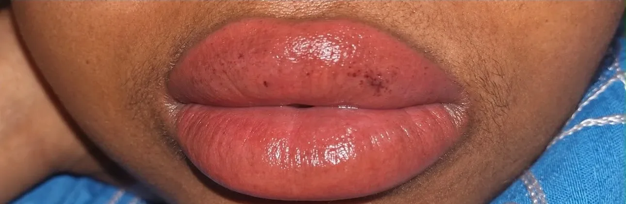 Candy lips à Chessy, après le soin : teinte rosée