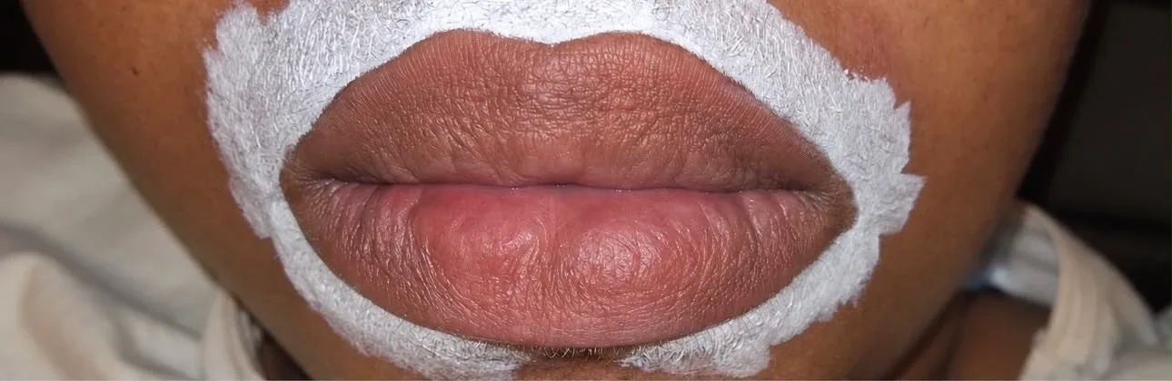 Candy lips à Chessy, avant le soin : lèvres foncées au départ